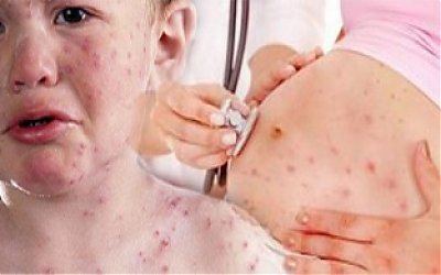 Bahaya Virus Rubella Serang Wanita Hamil di Masa Pembentukan Janin
