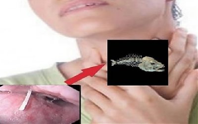 Bagaimana Cara Mengatasi Duri Ikan di Tenggorokan?