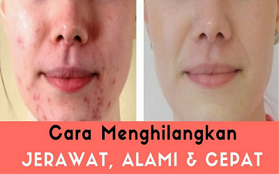 Tips Ampuh Menghilangkan Bekas Jerawat Secara Alami