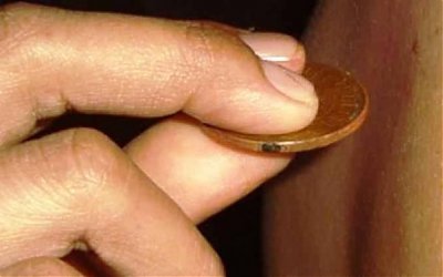 Merasa Masuk Angin? Jangan Buru-Buru Kerokan