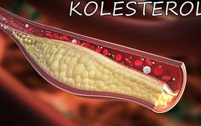 Masalah Kesehatan Yang Ditimbulkan Akibat Tingginya Kolesterol