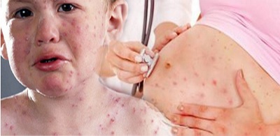 Bahaya Virus Rubella Serang Wanita Hamil di Masa Pembentukan Janin