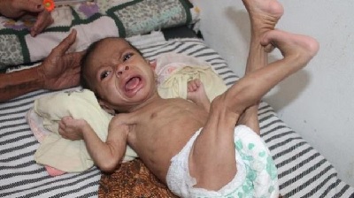 Dr Damayanti: Stunting bisa Dicegah Sebelum Bayi Berusia 2 tahun  dengan Asupan Gizi yang Memadai